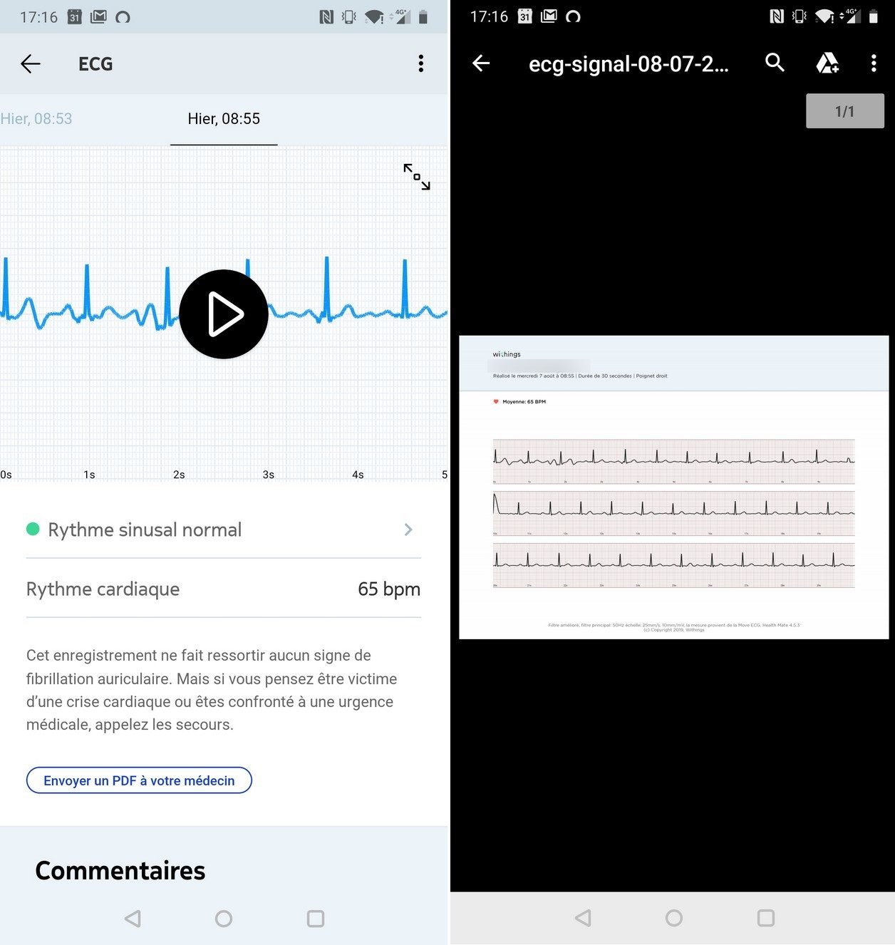 Les résultats de l'ECG qui apparaissent sur l'application.